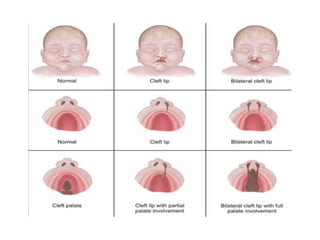 cleft lip palate anatomy embryology types management.pptx
