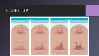 CLEFT LIP
 