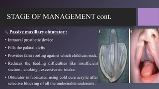 STAGE OF MANAGEMENT cont.
1. Passive maxillary obturator :
• Intraoral prosthetic device
• Fills the palatal clefts
• Provides false roofing against which child can suck.
• Reduces the feeding difficulties like insufficient
suction , choking , excessive air intake.
• Obturator is fabricated using cold cure acrylic after
selective blocking of all the undesirable undercuts .
 