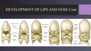 DEVELOPMENT OF LIPS AND NOSE Cont.
Frontonasal Prominence
Nasal Placode
Nasal Pit
Oral Opening
Maxillary
Process
Mandibular
Arch
Nasomedial Process
Nasolateral
Process
Nasolacrimal
Groove
Mandible
Maxillary
Process
Nasolateral
Process
Nasomedial
Processes
Merging
Philtrum
or Lip
Ear Tubercle
Ear
Hyoid bone
Laryngeal
Cartilages
 