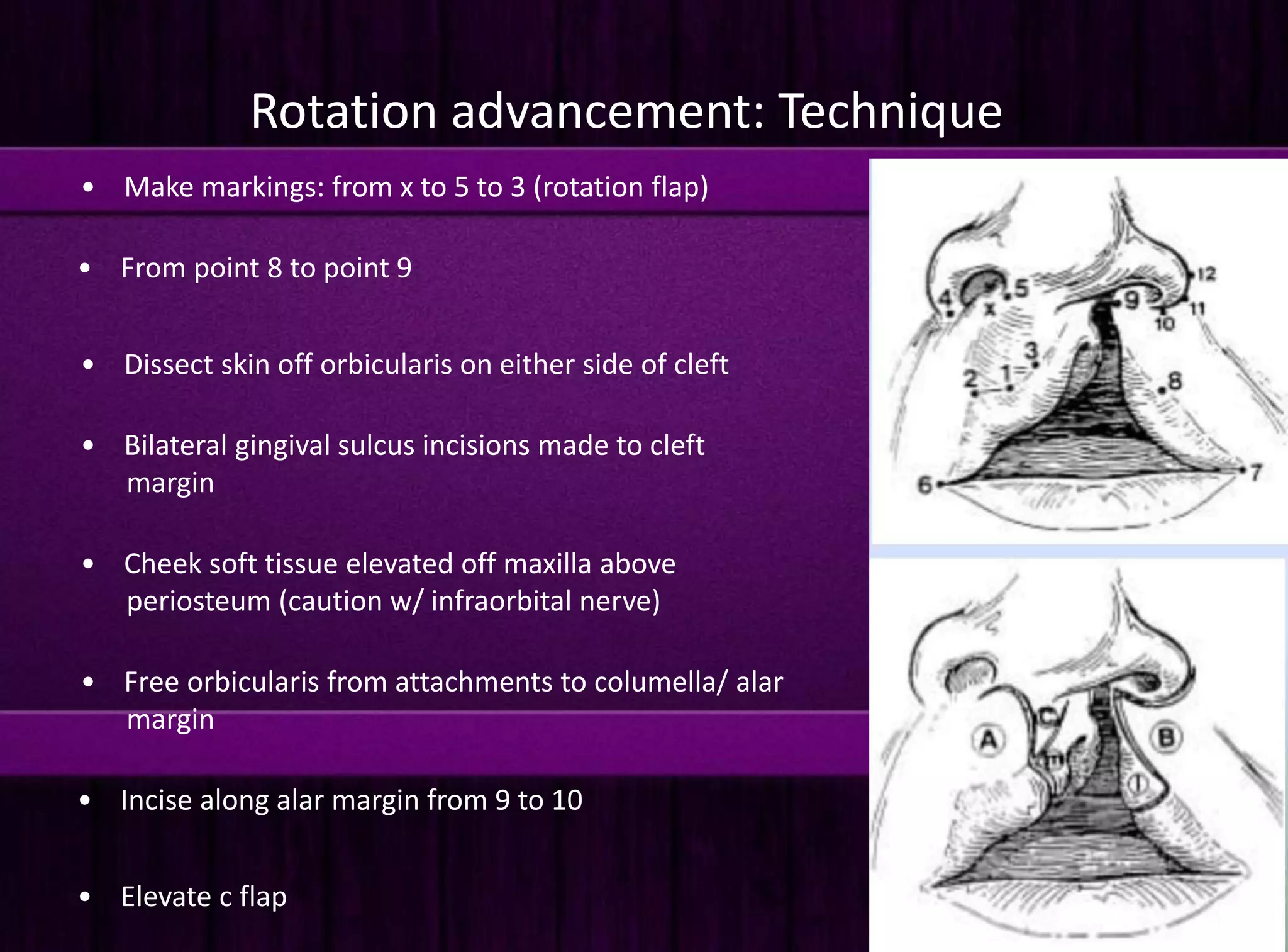 Cleft lip repair | PPTX
