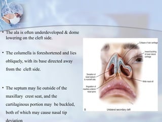 CLEFT NOSE CLEFT NOSE RHINOPLASTY v.pptx
