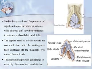 CLEFT NOSE CLEFT NOSE RHINOPLASTY v.pptx