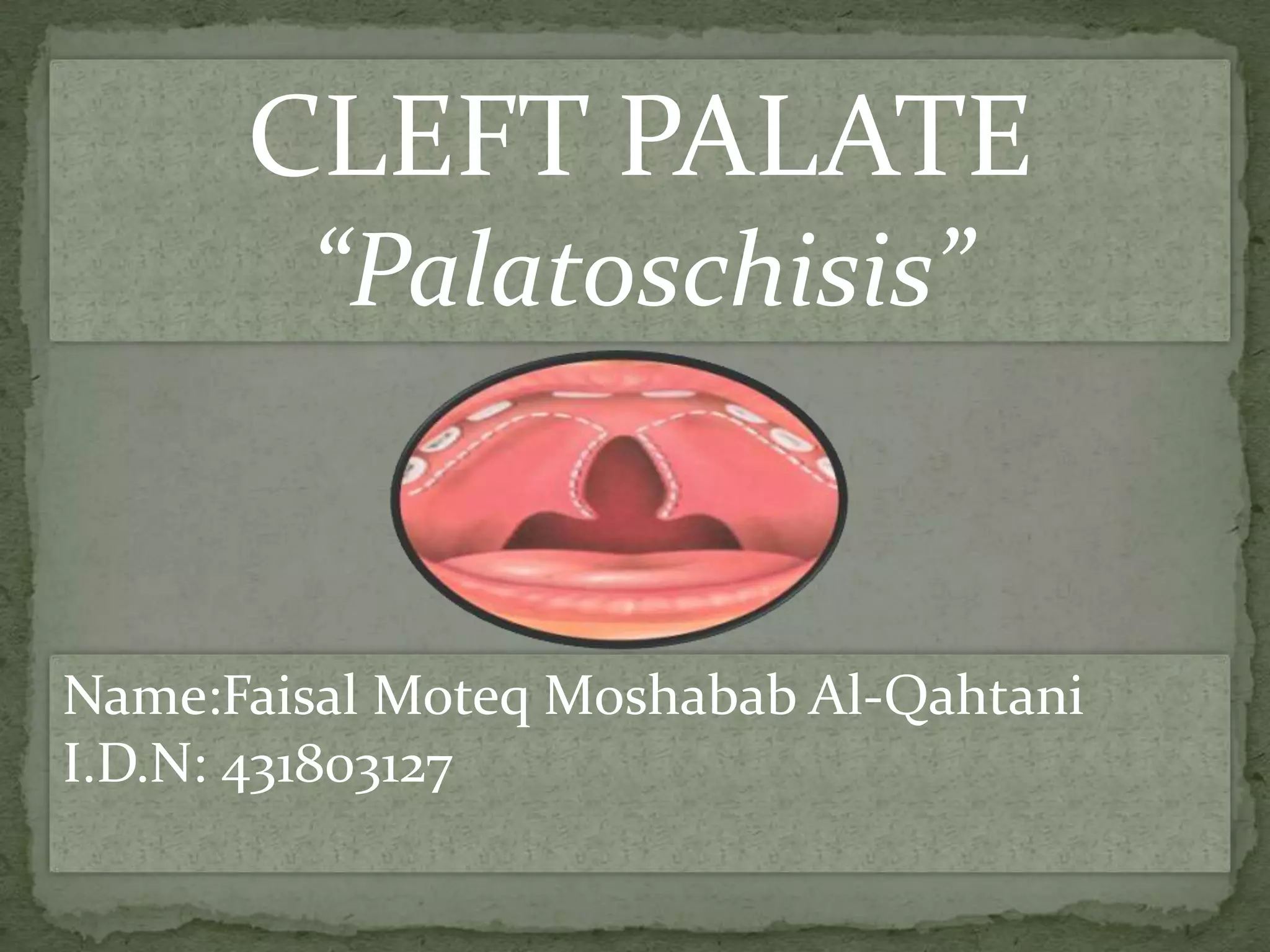 Cleft palate dental oral pathology PPT