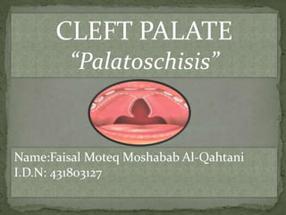 CLEFT PALATE
“Palatoschisis”

Name:Faisal Moteq Moshabab Al-Qahtani
I.D.N: 431803127

 