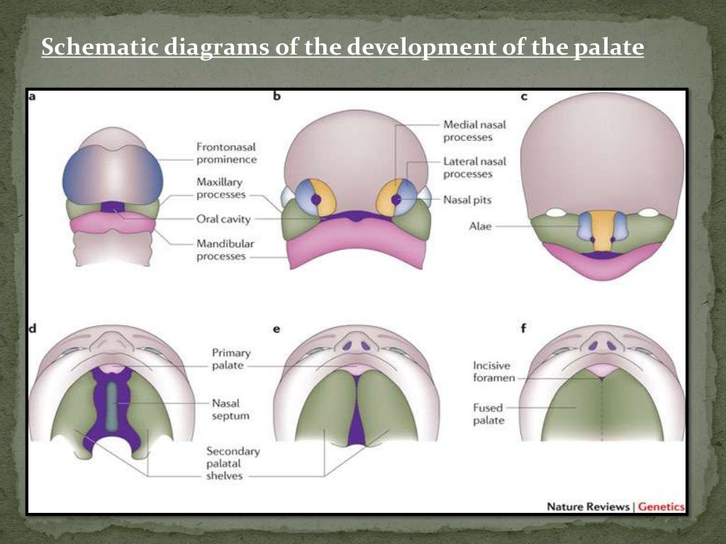 Cleft palate dental oral pathology