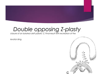 Double opposing Z-plasty
closure of an isolated cleft palate. C: Final result with recreation of the
levator sling.
 