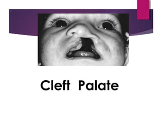 Cleft Palate
 