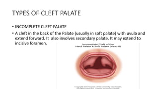 TYPES OF CLEFT PALATE
• INCOMPLETE CLEFT PALATE
• A cleft in the back of the Palate (usually in soft palate) with uvula and
extend forward. It also involves secondary palate. It may extend to
incisive foramen.
 