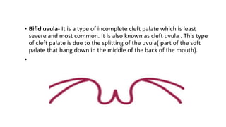 • Bifid uvula- It is a type of incomplete cleft palate which is least
severe and most common. It is also known as cleft uvula . This type
of cleft palate is due to the splitting of the uvula( part of the soft
palate that hang down in the middle of the back of the mouth).
•
 