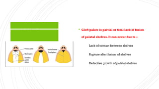 An overview of cleft palate & its management | PPTX