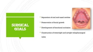 An overview of cleft palate & its management | PPTX