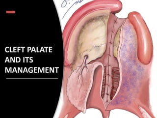 CLEFT PALATE
AND ITS
MANAGEMENT
 