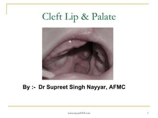 1
Cleft Lip & Palate
By :- Dr Supreet Singh Nayyar, AFMC
www.nayyarENT.com
 