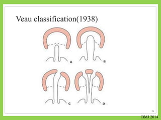 Veau Classfication cleft lip and Cleft Palate Rehabilitation | PPTX