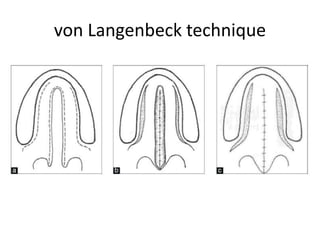 von Langenbeck technique
 