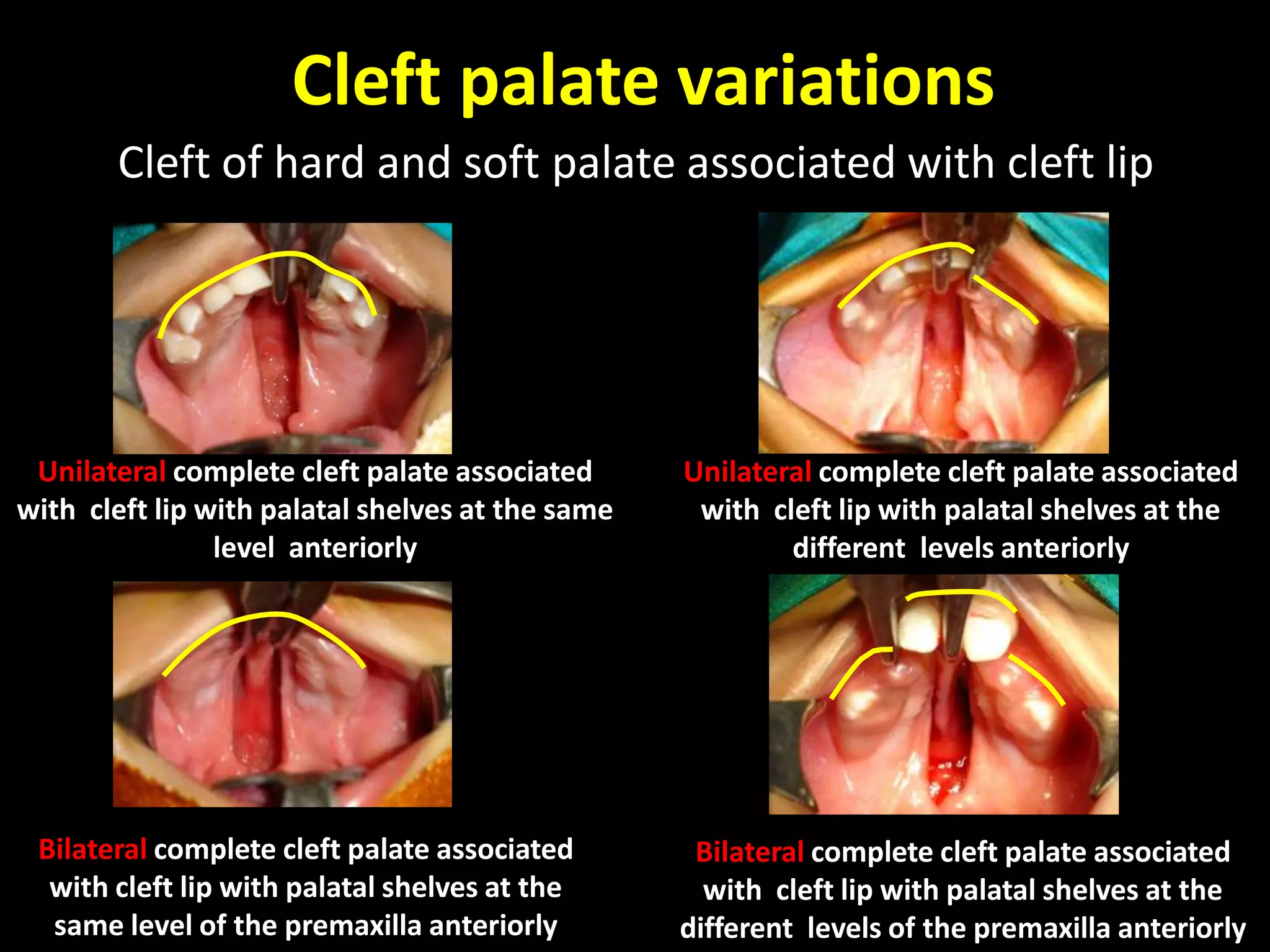 Polydactyly visual data 3