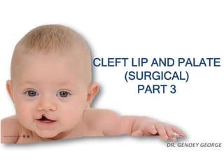 DR. GENOEY GEORGE
CLEFT LIP AND PALATE
(SURGICAL)
PART 3
 