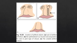 CLEFT POST SURGICAL COMPLICATIONS.pptx.... | PPTX