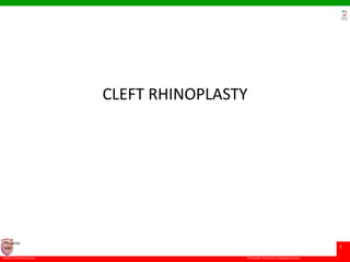 © Ramaiah University of Applied Sciences
1
Faculty of Dental Sciences
University
Logo
CLEFT RHINOPLASTY
 
