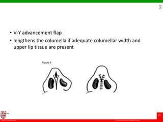 Cleft rhinoplasty | PPTX