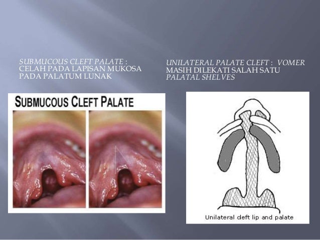 Cleft Unsoed Cleft Unsoed