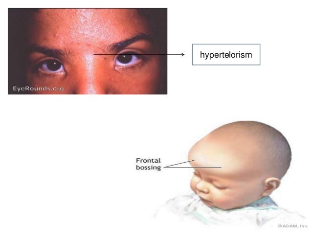 cleidocranial dysplasia