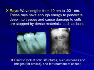 X-Rays
X-Rays: Wavelengths from 10 nm to .001 nm.
: Wavelengths from 10 nm to .001 nm.
These rays have enough energy to penetrate
These rays have enough energy to penetrate
deep into tissues and cause damage to cells;
deep into tissues and cause damage to cells;
are stopped by dense materials, such as bone.
are stopped by dense materials, such as bone.
Used to look at solid structures, such as bones and
Used to look at solid structures, such as bones and
bridges (for cracks), and for treatment of cancer.
bridges (for cracks), and for treatment of cancer.
 