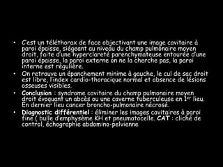 • C’est un téléthorax de face objectivant une image cavitaire à
paroi épaisse, siégeant au niveau du champ pulmonaire moyen
droit, faite d’une hyperclareté parenchymateuse entourée d’une
paroi épaisse, la paroi externe on ne la cherche pas, la paroi
interne est régulière.
• On retrouve un épanchement minime à gauche, le cul de sac droit
est libre, l’index cardio-thoracique normal et absence de lésions
osseuses visibles.
• Conclusion : syndrome cavitaire du champ pulmonaire moyen
droit évoquant un abcès ou une caverne tuberculeuse en 1er lieu.
En dernier lieu cancer broncho-pulmonaire nécrosé.
• Diagnostic différentiel : éliminer les images cavitaires à paroi
fine ( bulle d’emphysème KH et pneumatocelle. CAT : cliché de
control, échographie abdomino-pelvienne et TDM thoracique

 