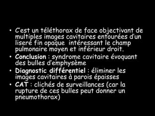 • C’est un téléthorax de face objectivant de
  multiples images cavitaires entourées d’un
  liseré fin opaque intéressant le champ
  pulmonaire moyen et inférieur droit.
• Conclusion : syndrome cavitaire évoquant
  des bulles d’emphysème
• Diagnostic différentiel : éliminer les
  images cavitaires à parois épaisses
• CAT : clichés de surveillances (car la
  rupture de ces bulles peut donner un
  pneumothorax)
 