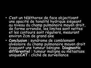 • C’est un téléthorax de face objectivant
  une opacité de tonalité hydrique siégeant
  au niveau du champ pulmonaire moyen droit,
  de forme arrondie, les limites sont nettes
  et les contours sont réguliers, mesurant
  environ 2cm de grand axe
• Conclusion : syndrome de comblement
  alvéolaire du champ pulmonaire moyen droit
  évoquant une tumeur bénigne Diagnostic
  différentiel : tumeur maligne ou métastase
  uniqueCAT : cliché de surveillance
 