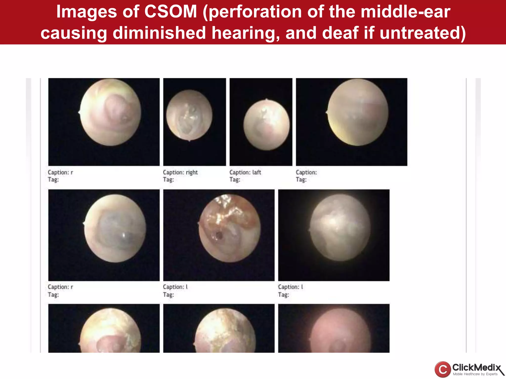 Images of CSOM (perforation of the middle-ear
causing diminished hearing, and deaf if untreated)
 