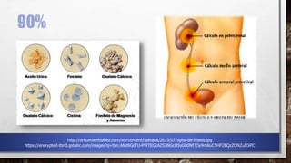 90%
http://drhumbertoanez.com/wp-content/uploads/2015/07/tipos-de-litiasis.jpg
https://encrypted-tbn0.gstatic.com/images?q=tbn:ANd9GcTU-PWTEGcAZS3NGcO5sGb0NFJOy9rb8uC5HF2BQzZONZuIOiPC
 