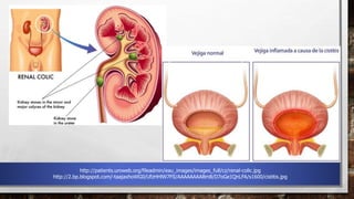 http://patients.uroweb.org/fileadmin/eau_images/images_full/cz/renal-colic.jpg
http://2.bp.blogspot.com/-taajaxhoWG0/UfzHHlW7FlI/AAAAAAAABm8/D7oGe1QnLFA/s1600/cistitis.jpg
 