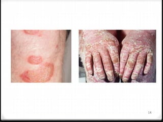 dermatological infections | PPTX