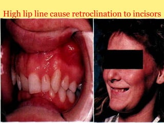 High lip line cause retroclination to incisors

 