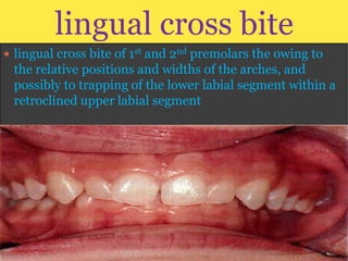 lingual cross bite
 lingual cross bite of 1st and 2nd premolars the owing to

the relative positions and widths of the arches, and
possibly to trapping of the lower labial segment within a
retroclined upper labial segment

 
