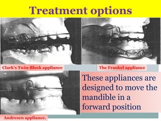Treatment options

Clark's Twin-Block appliance

The Frankel appliance

These appliances are
designed to move the
mandible in a
forward position
Andresen appliance.

 