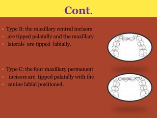 Cont.
 Type B: the maxillary central incisors

 are tipped palatally and the maxillary
 laterals are tipped labially.

 Type C: the four maxillary permanent

incisors are tipped palatally with the
 canine labial positioned.


 