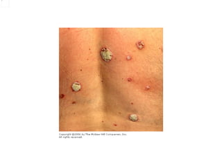 Plect Medicine 6th year, Dermatology Tutorial (3rd session) | PPT