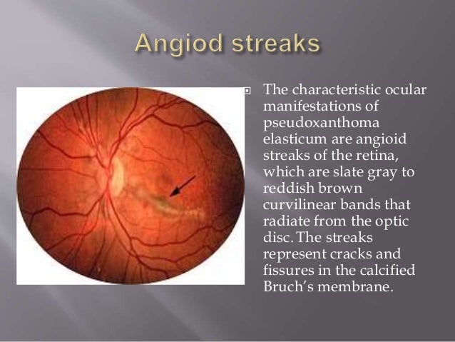 Clincal Features Of Stable Cad Clincal Features Of Stable Cad