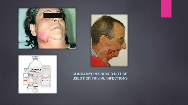 450 mg of clindamycin