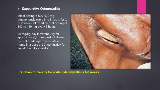 clindamycin 300mg po tid