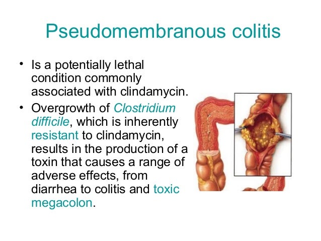 clindamycin skin rash clindamycin skin rash
