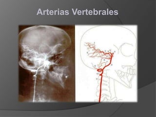 Arterias Vertebrales
 