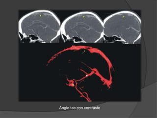 Angio tac con contraste
 
