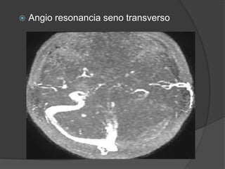    Angio resonancia seno transverso
 