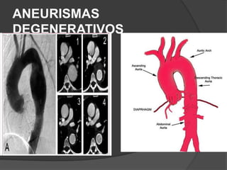ANEURISMAS
DEGENERATIVOS
 