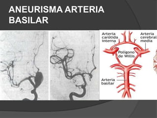 ANEURISMA ARTERIA
BASILAR
 