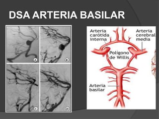 DSA ARTERIA BASILAR
 